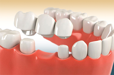dental implants hyderabad